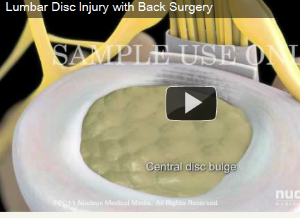 lower back pain from a lumbar disc bulge